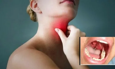 Cần làm gì khi bị hóc xương?