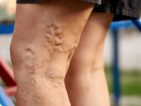 Các thói quen cần tránh vì dễ gây giãn tĩnh mạch chân