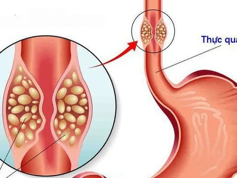 Ung thư thực quản: liên quan tới các thói quen hằng ngày như hút thuốc lá, rượu