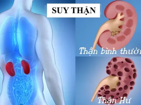 Những việc bạn đang làm hằng ngày có thể khiến thận suy yếu dần theo thời gian