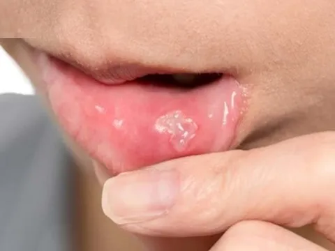 Cách trị nhiệt miệng an toàn hiệu quả tận gốc tại nhà